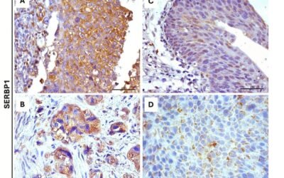 Efeitos clínicos e imuno-histoquímicos da nanoimunoterapia OncoTherad (MRB-CFI-1) em SERBP1, HABP4, CD44 e Ki-67 no câncer de bexiga não músculo invasivo resistente a BCG.